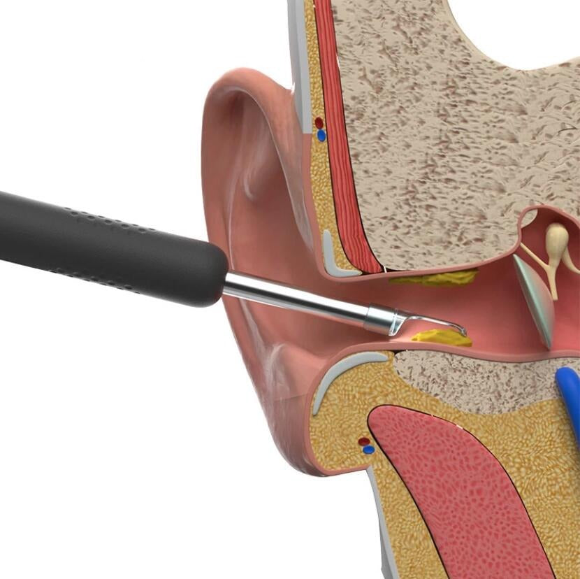 OtoClear™ – Otoscope d'Elimination du Cérumen Oreille Intelligent